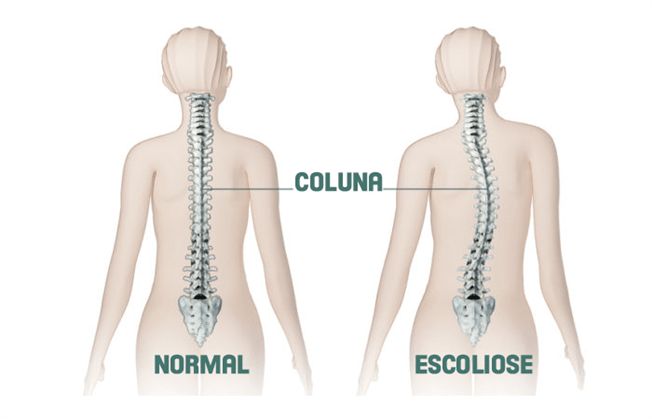 Escoliose em crianças vs. adultos: diferenças fundamentais