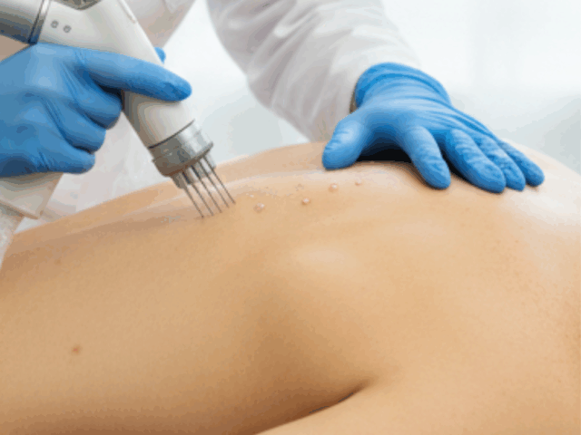 Mesoterapia no tratamento de dores crônicas ortopédicas: como funciona e seus benefícios