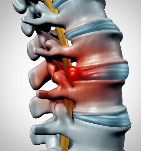 Hérnia de disco: por que a cirurgia nem sempre é o primeiro passo no tratamento