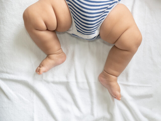 Displasia do quadril em bebês: diagnóstico precoce faz toda a diferença
