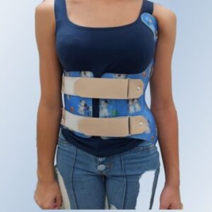 Colete ortopédico na escoliose: por que o tempo de uso é decisivo