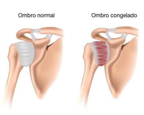 Dor no ombro durante a menopausa? Pode ser capsulite adesiva
